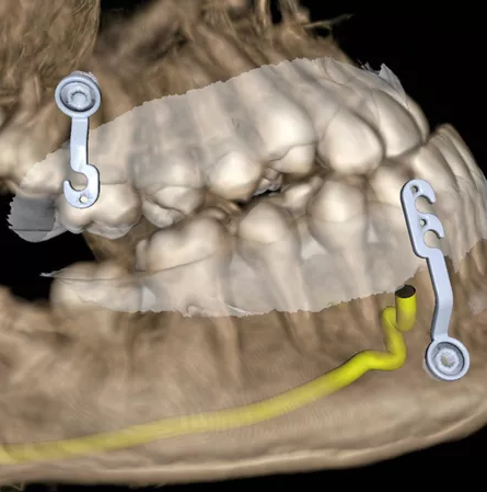 Ortho Stable: evolução conceitual da ancoragem esquelética